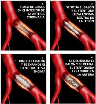 La angioplastia coronaria (ACTP, stent) en los pacientes con insuficiencia cardiaca.