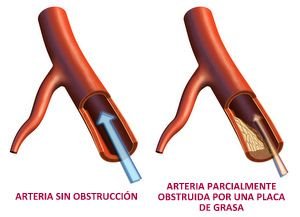 El Cateterismo cardiaco, la Coronariograf�a, la Angioplastia con stent en la Insuficiencia Cardiaca