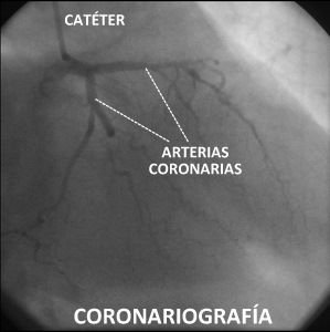 La coronariografia se realiza con anestesia local.