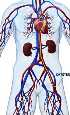 La coronariografia permite ver las arterias coronarias de los pacientes con insuficiencia cardiaca.