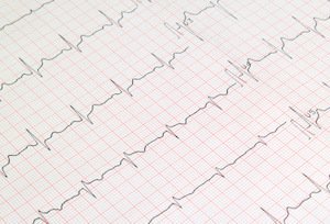 El holter de ECG registra 24 horas del electrocardiograma del paciente.