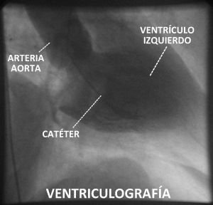 La ventriculografia permite ver los ventriculos de los pacientes con Insuficiencia Cardiaca.